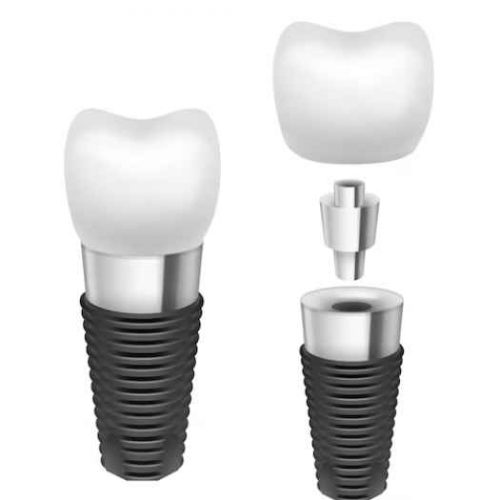 dental implantss